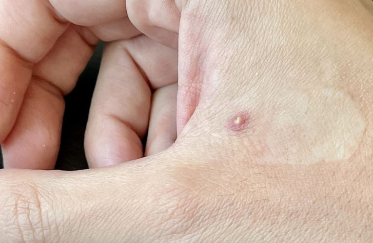 Health News: Only Lab Test Can Confirm Monkeypox, Says Health Minister