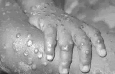 Federal Government Gives Prevention Measures On Monkey Pox