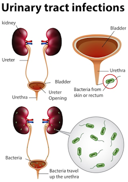 Preventing UTIs: Expert Tips for a Healthy Urinary Tract