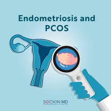 Endometriosis and PCOS: What You Should Know